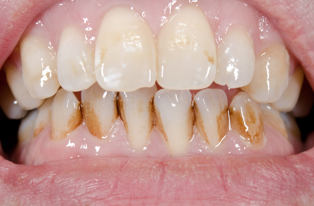 dental-health-concerns-for-smokers