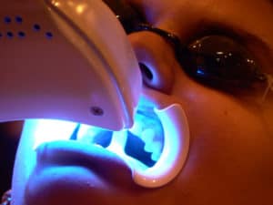 Does teeth whitening hurt?