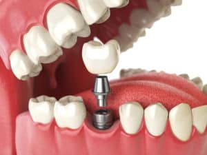 Dental Implants in West Orange, NJ