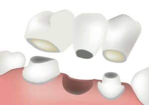 Understanding dental bridges