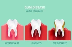 Reducing gum disease risk West Orange, NJ