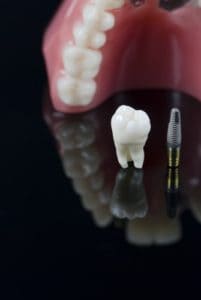 Dentures vs. Dental Implants in West Orange, NJ