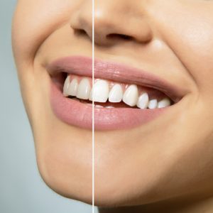 Cosmetic dentistry in West Orange, NJ