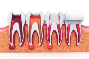 Root Canal in West Orange NJ