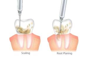 Scaling and Root Planing Procedure West Orange NJ