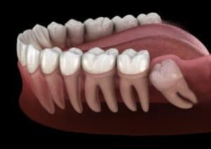 Tooth Extraction Short Hill and Livingston